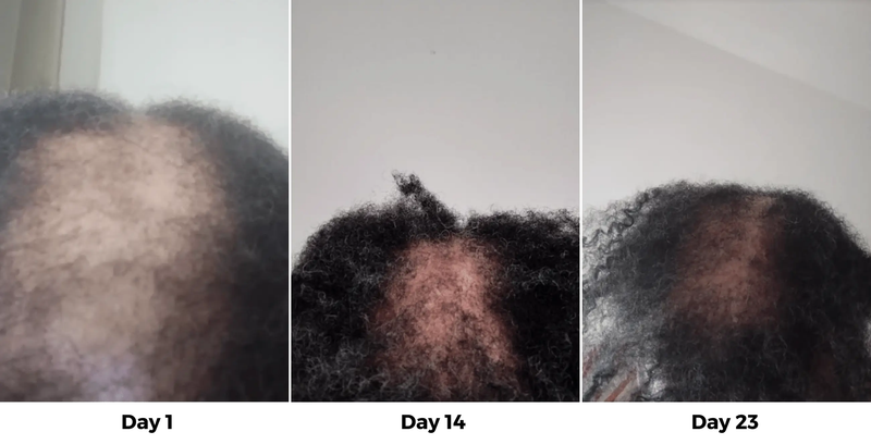 My Pharmacist Never Warned Me. My Doctor Never Warned Me. Not One Person Told Me This Medication Would Take My Hair.